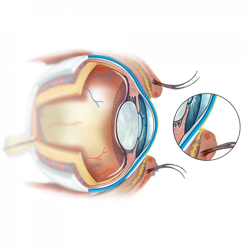 Illustration de la capsulotomie au laser YAG