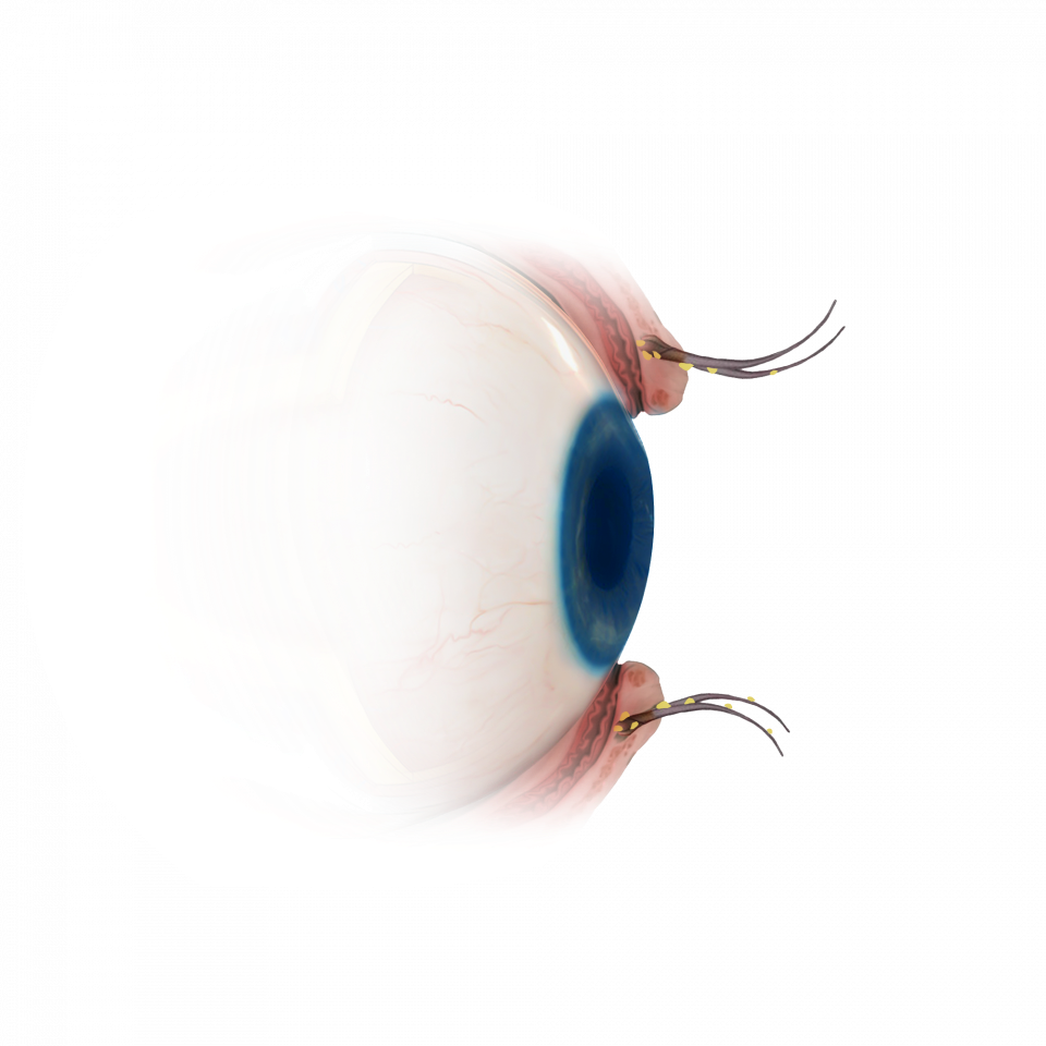Illustration de la capsulotomie au laser YAG