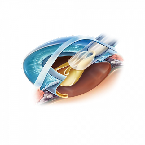 Implant posé lors d'une chirurgie PRELEX