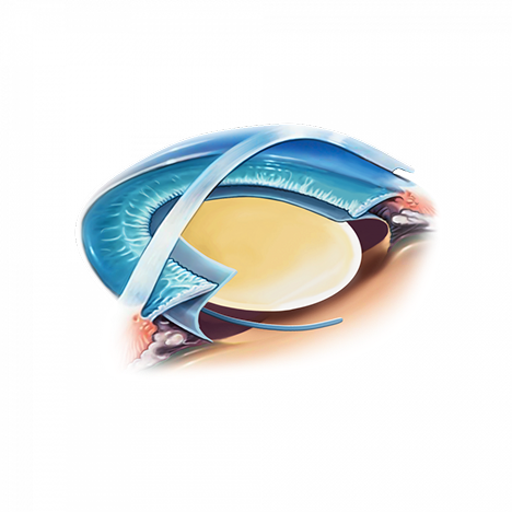 Illustration du choix d'implant sur mesure