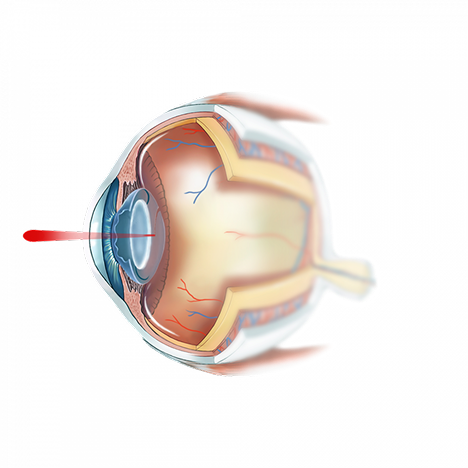 Illustration de la capsulotomie au laser YAG