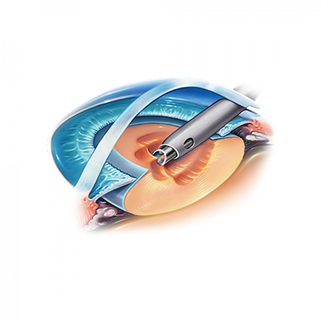 Illustration de la chirurgie PRELEX