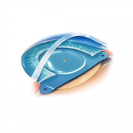 Schéma d'un implant phaque