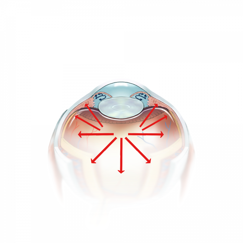 Illustration de la cataracte