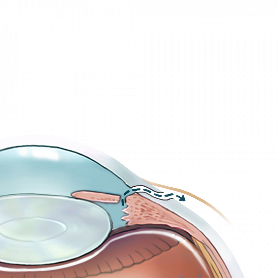 Illustration de la cataracte
