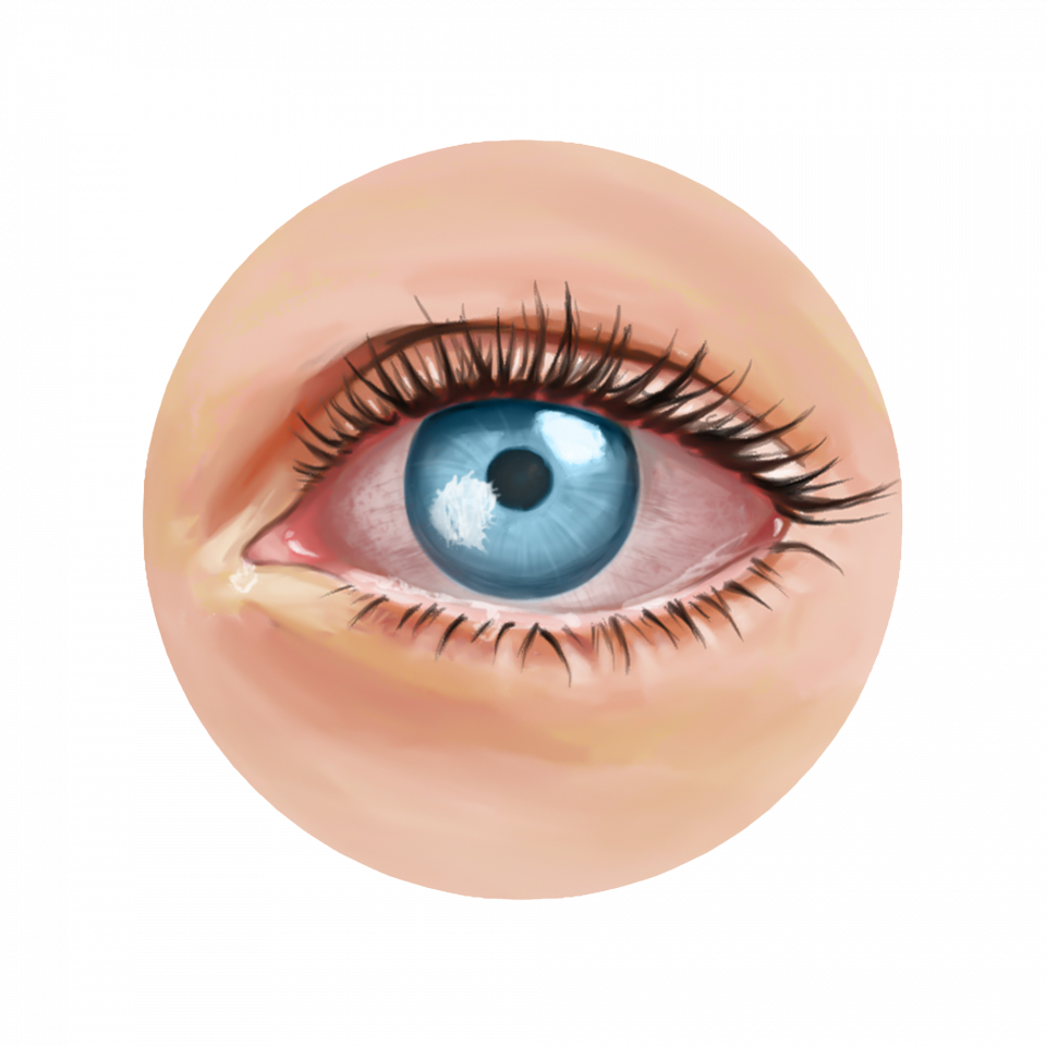 Infection de la cornée liée au port de lentilles