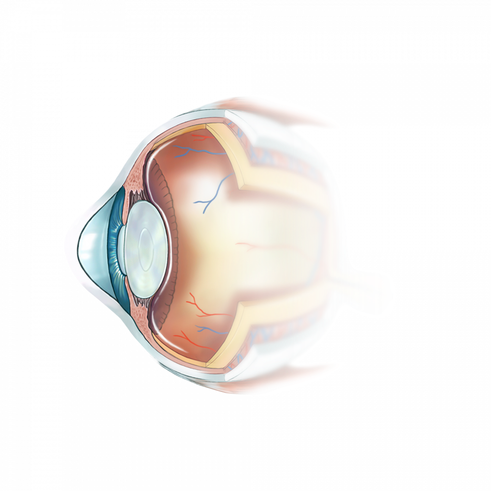 Illustration de la cataracte