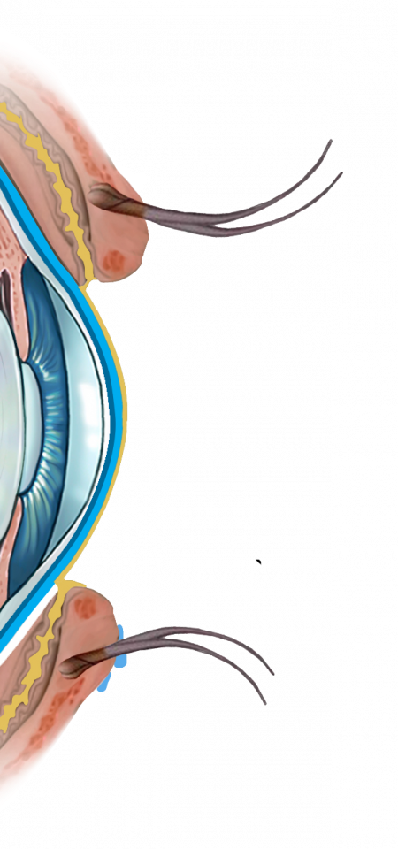 Illustration de la sélection d'implants