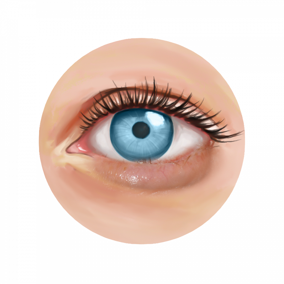 Illustration de la sélection d'implants