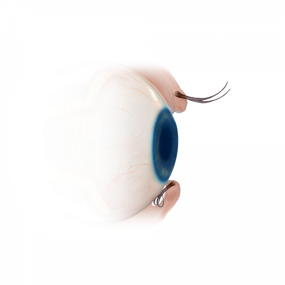 Illustration de la sélection d'implants