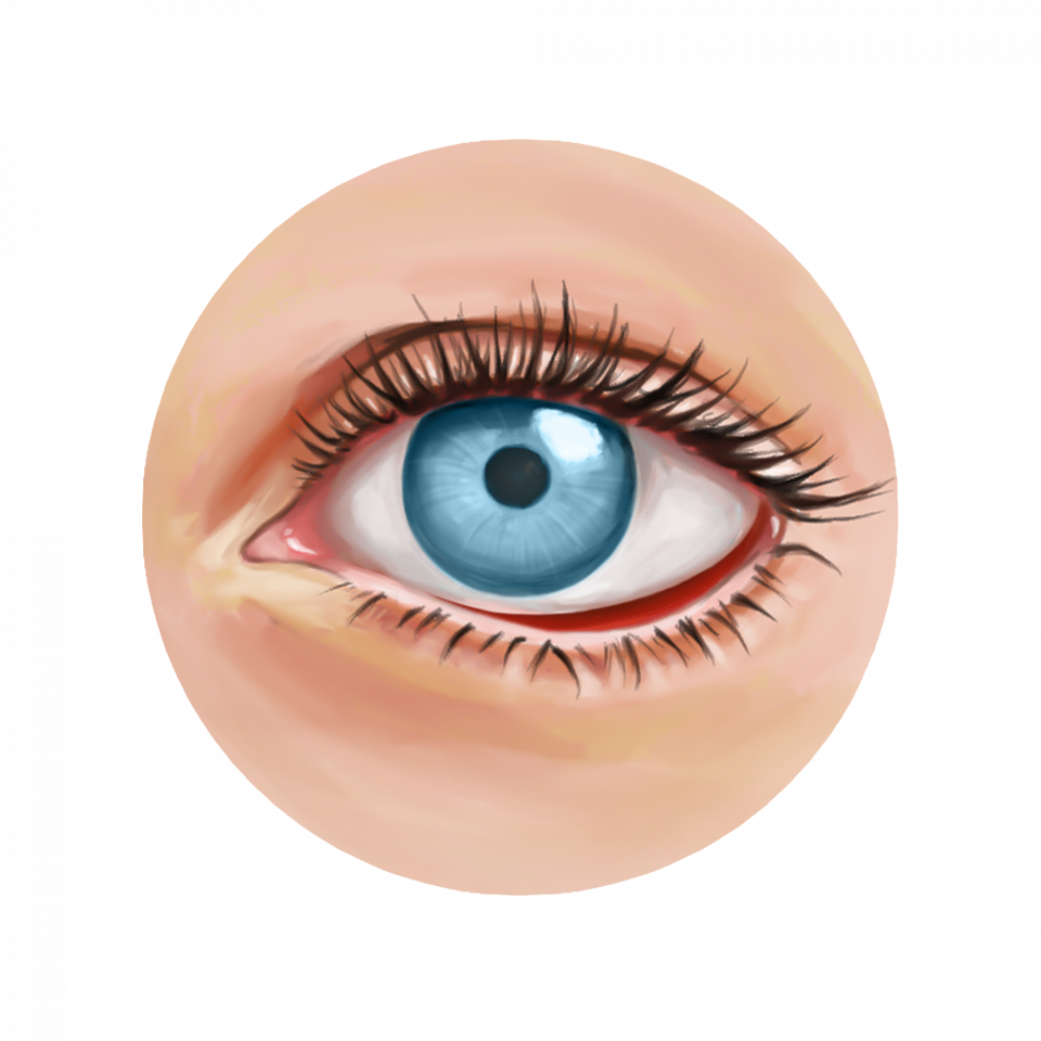 Illustration de la sélection d'implants