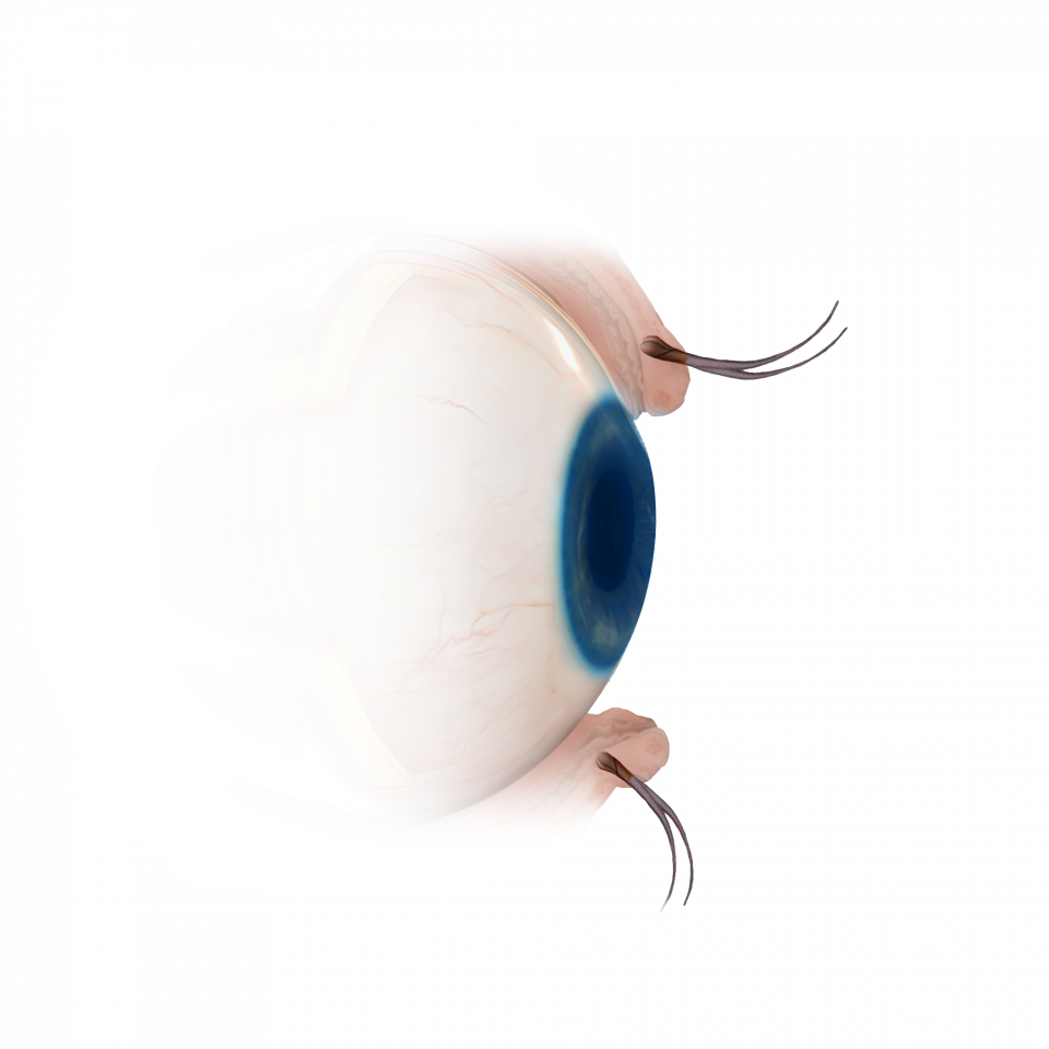 Illustration de la sélection d'implants