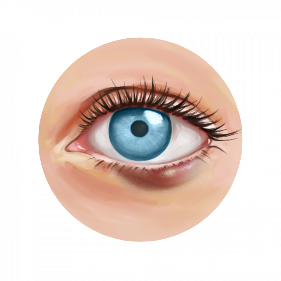 Illustration d’un chalazion sur la paupière inférieure