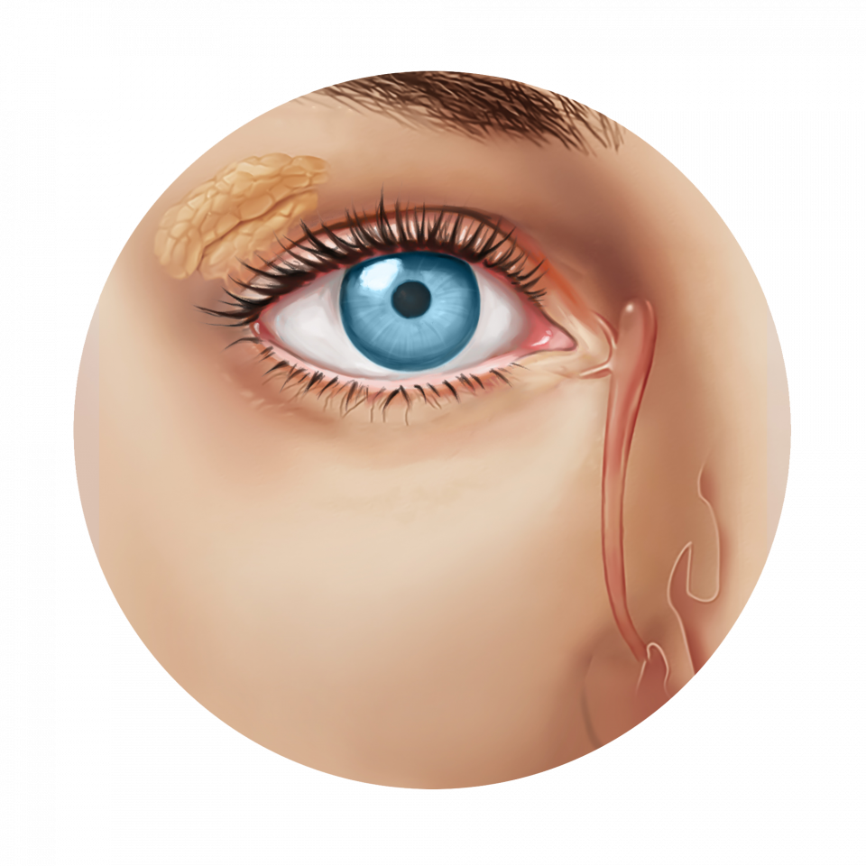 Illustration de la sélection d'implants