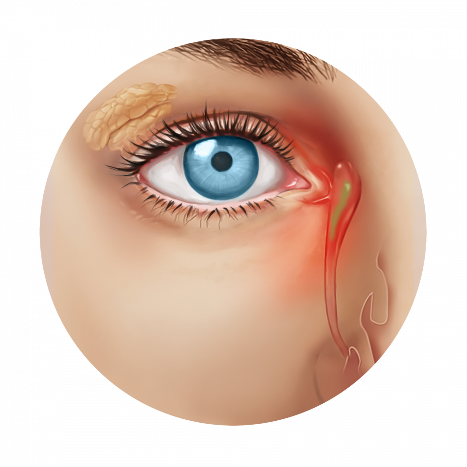 Illustration de la sélection d'implants