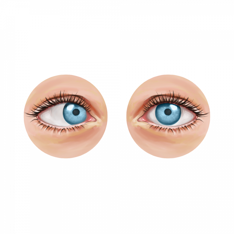 Illustration de la cataracte