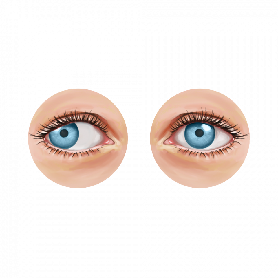 Illustration de la cataracte