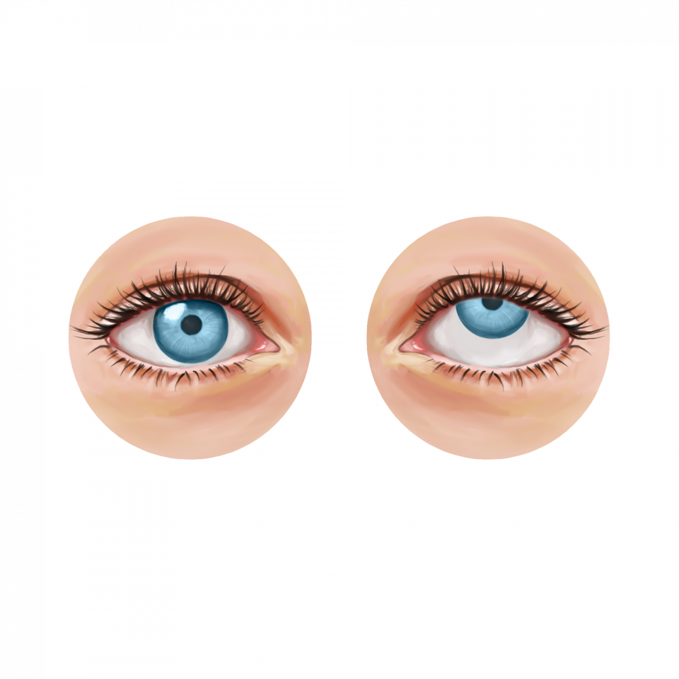 Illustration de la cataracte