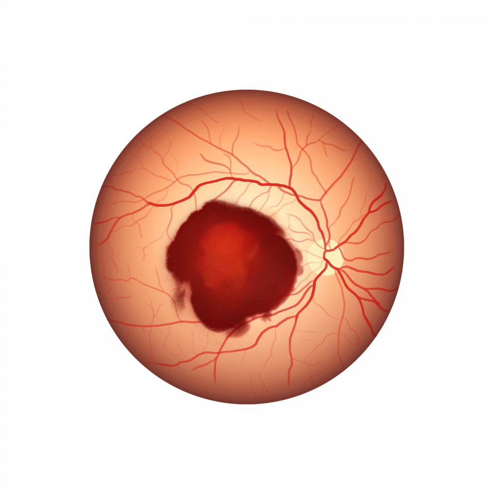 Illustration d'un hématome sous-maculaire