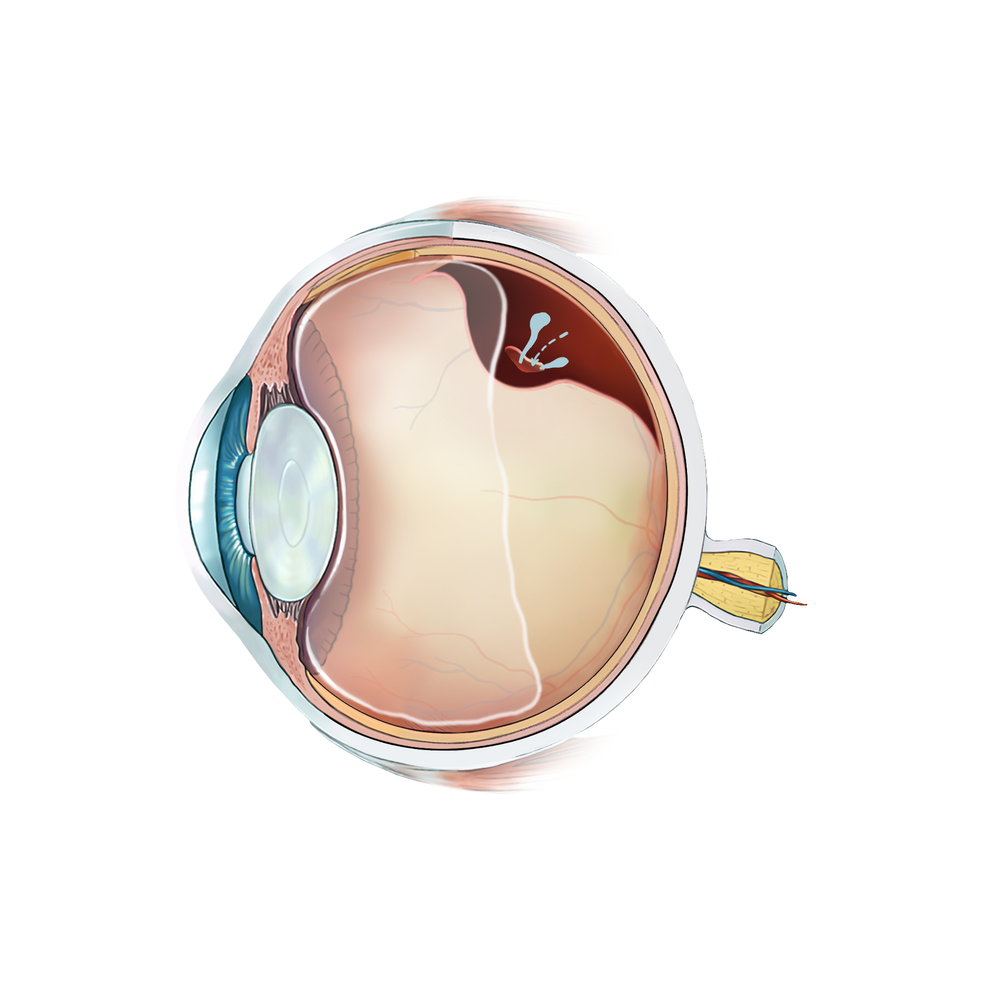 Illustration d'un décollement de rétine