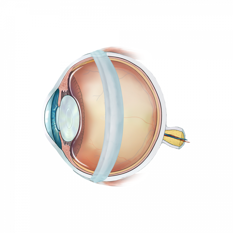 Illustration d'un décollement de rétine