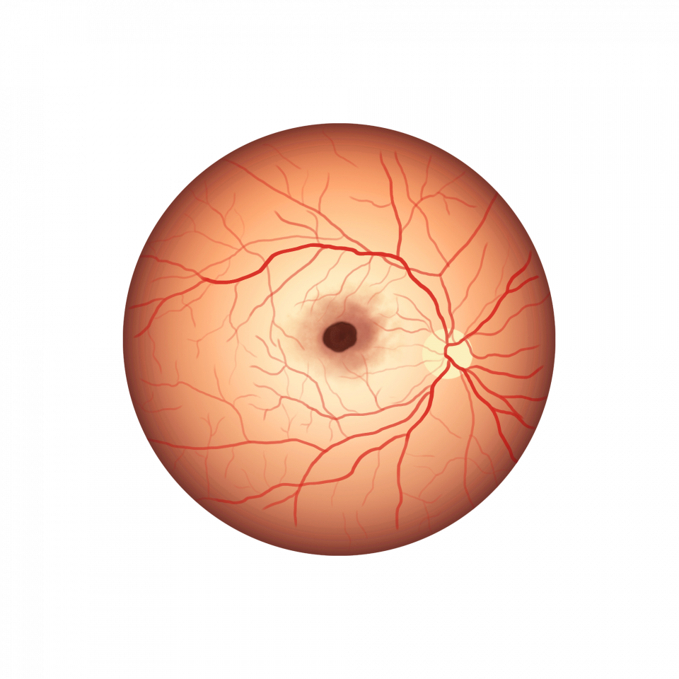 Illustration d'un trou maculaire