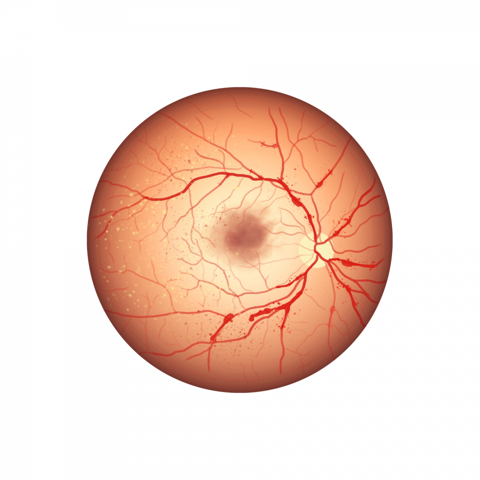 Illustration d'une rétinopathie diabétique