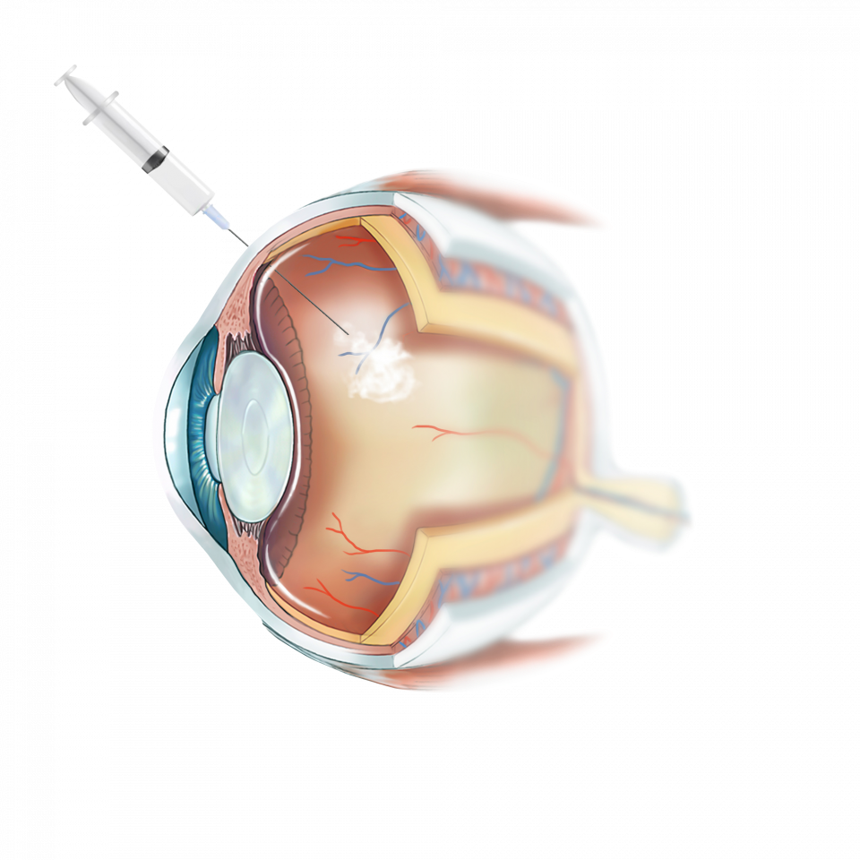 Fond d’œil présentant une occlusion veineuse