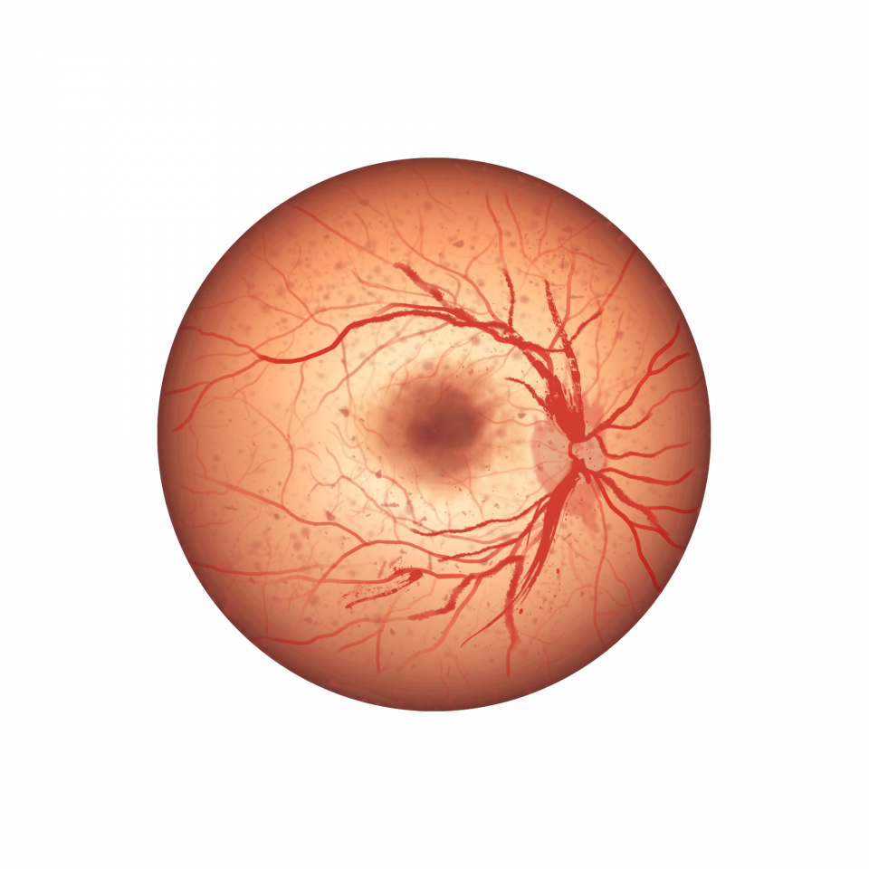 Fond d’œil présentant une occlusion veineuse